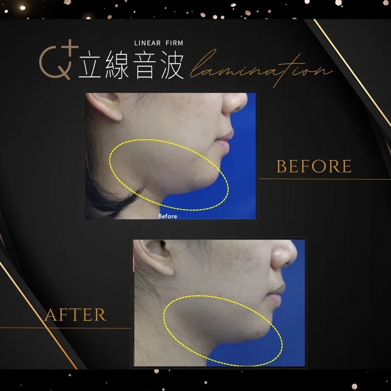 音波拉提 產品圖 4