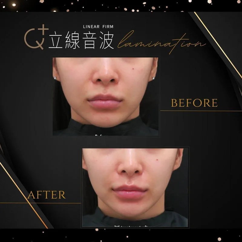 音波拉提 產品圖 5