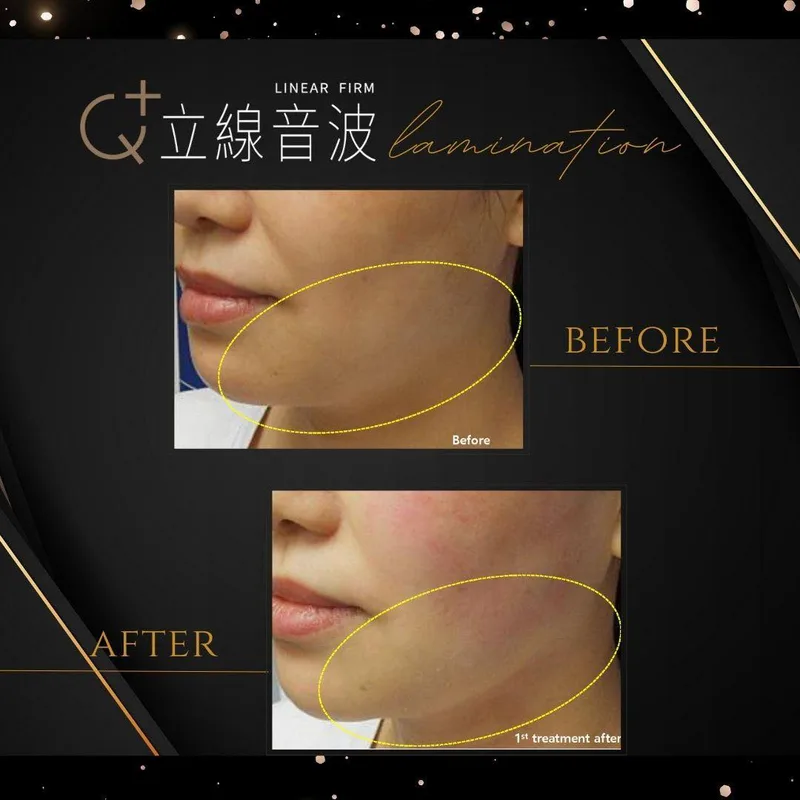 音波拉提 產品圖 6