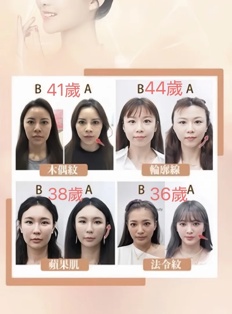 埋線拉提 產品圖 1