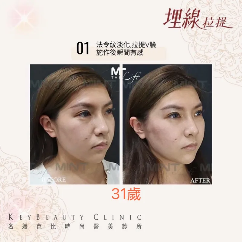 埋線拉提 產品圖 2