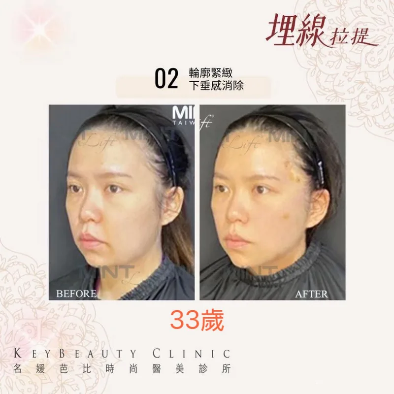 埋線拉提 產品圖 3