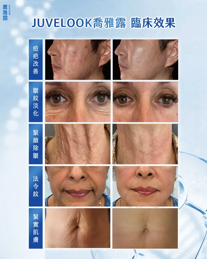 Juvelook 臨床效果 — 痘疤改善、皺紋淡化、緊緻除皺、法令紋改善、緊實肌膚